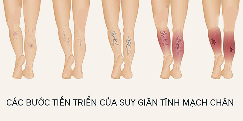 Nguyên nhân giãn tĩnh mạch chân